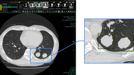 肺結節検出機能