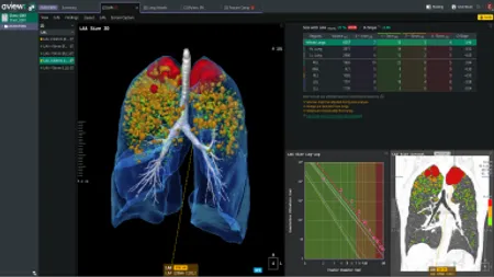 Aビュー”COPD”