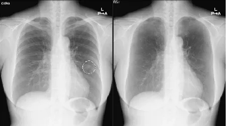 胸部X線画像診断支援ソフトウェア　CXR Finding-i