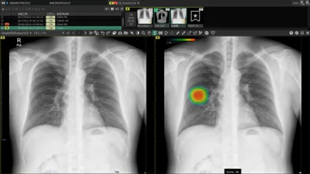 胸部X線画像病変検出ソフトウェア CXR-AID