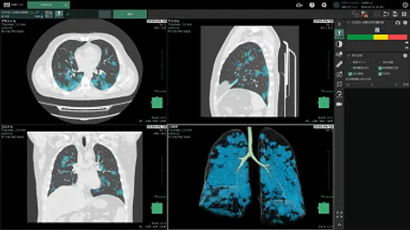 COVID-19肺炎画像ビューワ
