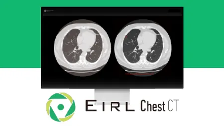 EIRL Chest CT