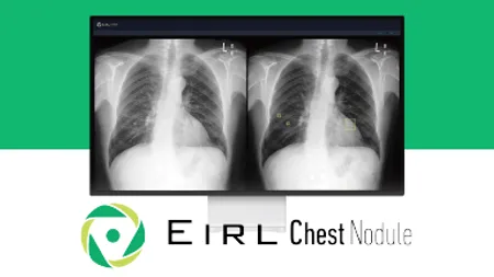 EIRL Chest Nodule