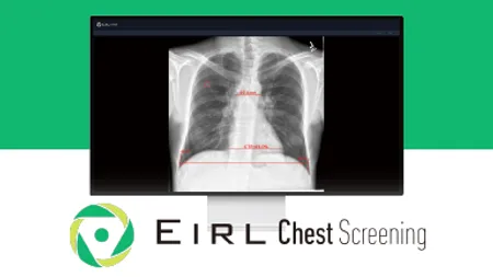 EIRL Chest Screening