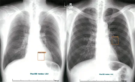 Plus.Lung.Nodule (CXR-AI)