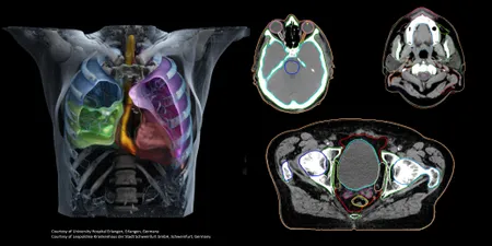 AI-Rad Companion Organs RT